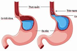 Viêm Dạ Dày Trào Ngược Thực Quản Độ A